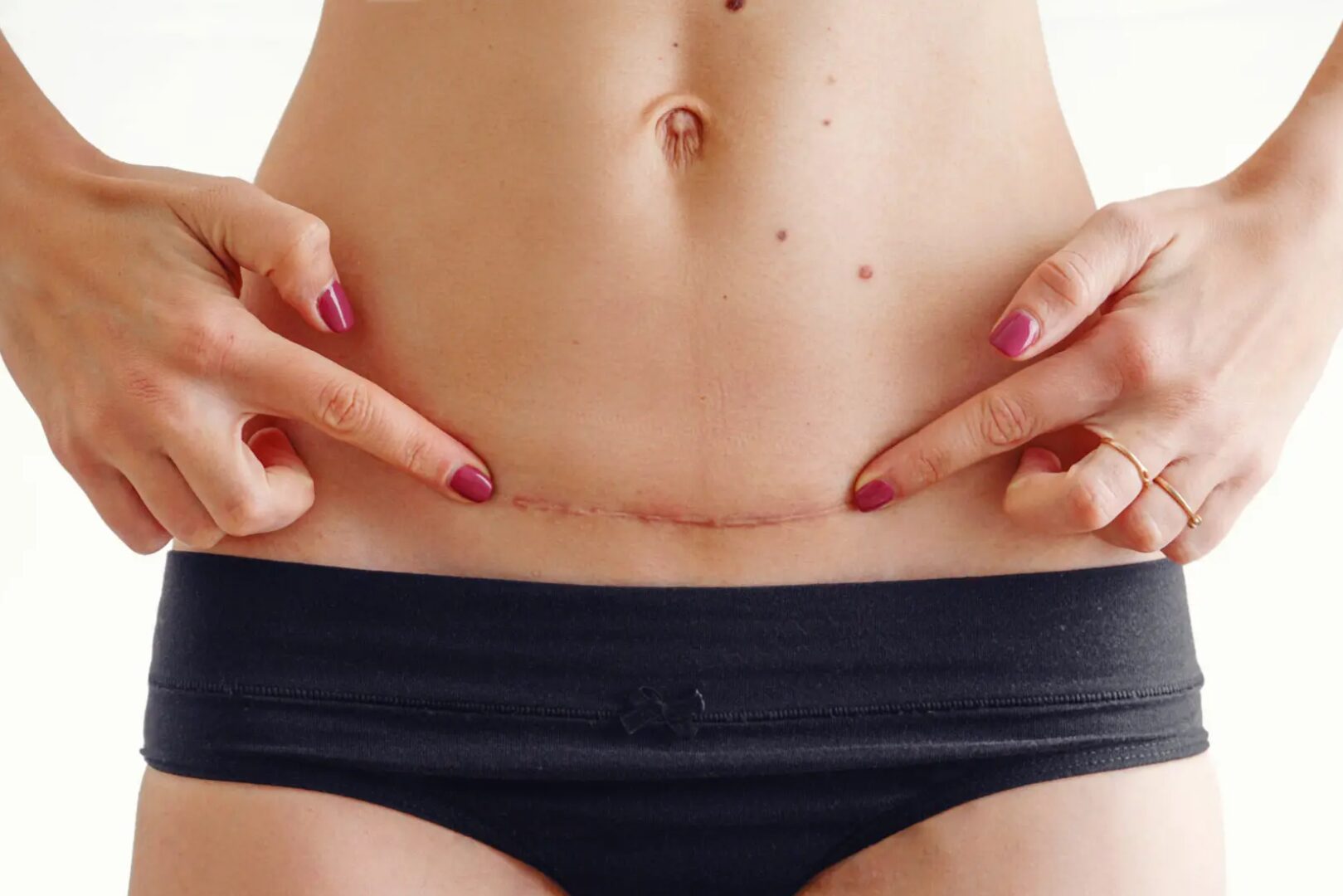 Woman with a fresh Tummy Tuck Scar doing self Lymphatic Drainage Massage