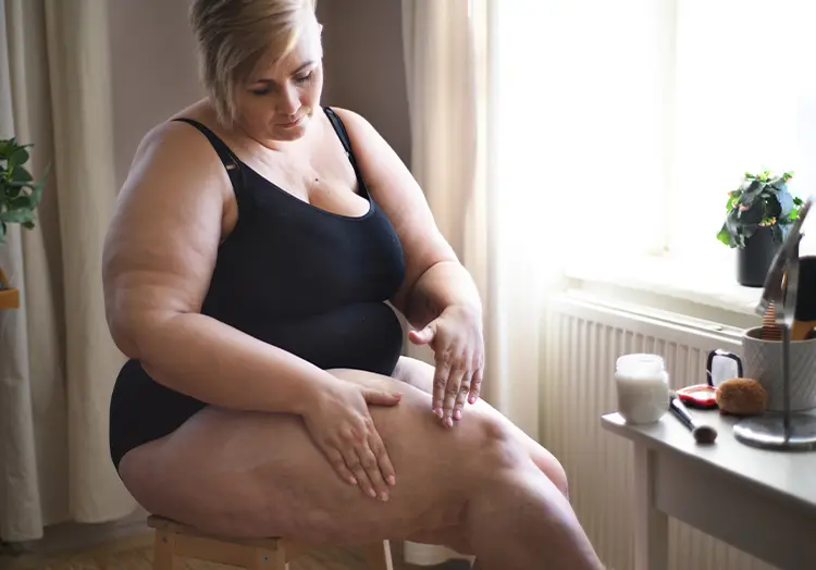 Dimpled skin, uneven skin texture, Lipedema Care: Reduce Swelling, Ease Pain, Improve Mobility